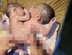 Bayi Kembar Siam Dengan Kaki Tiga, ‘Ini Kata dr Rizky Andriansyah